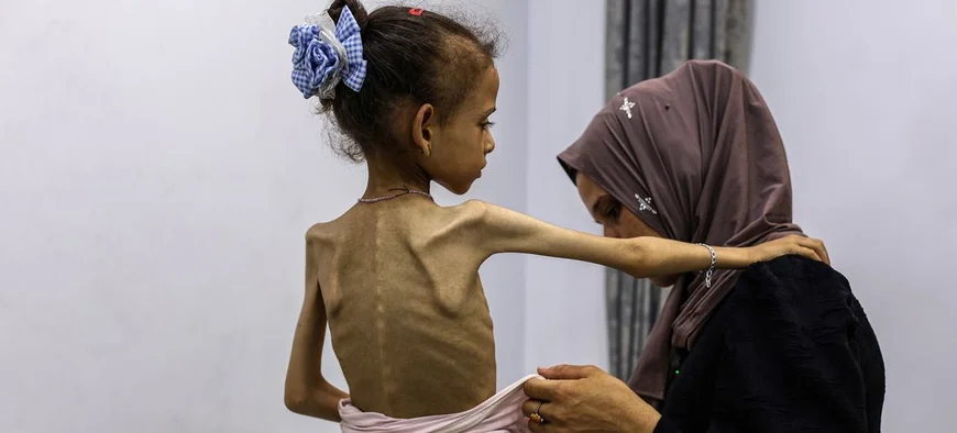 شهداء المجاعة 466 ضحية: 157 طفلاً وثقهم الإعلام بغزة
